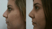 Rhinoplasty
