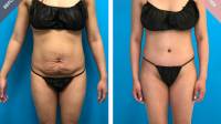 Tummy Tuck